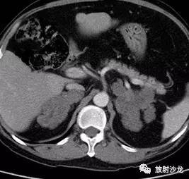 【病例】肾上腺淋巴瘤1例影像解析