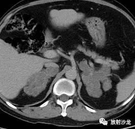 【病例】肾上腺淋巴瘤1例影像解析