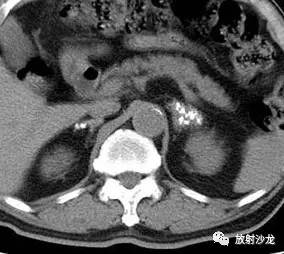 【病例】肾上腺淋巴瘤1例影像解析