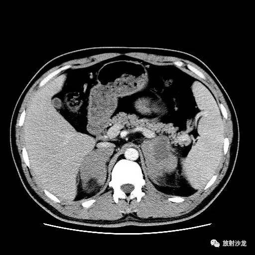 【病例】肾上腺淋巴瘤1例影像解析