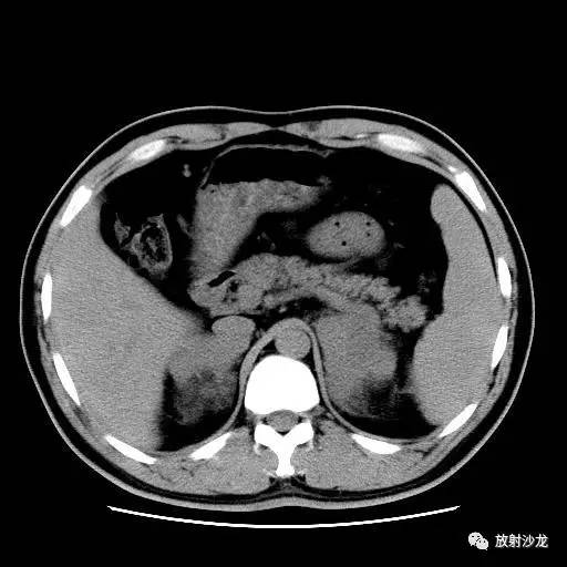【病例】肾上腺淋巴瘤1例影像解析