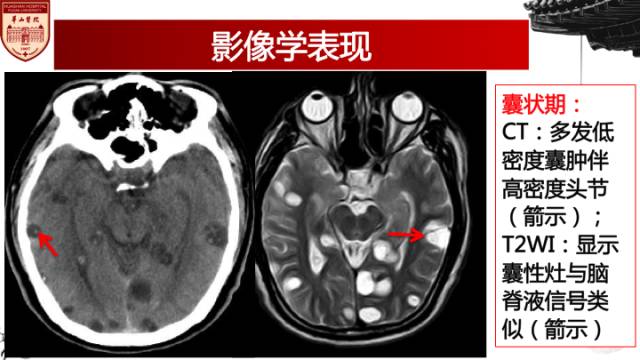 【病例】脑囊虫病1例MR影像诊断