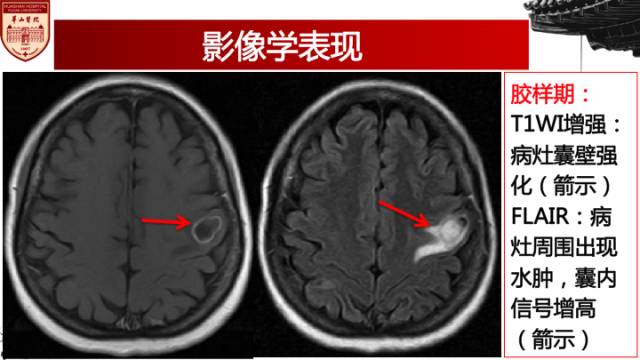 【病例】脑囊虫病1例MR影像诊断