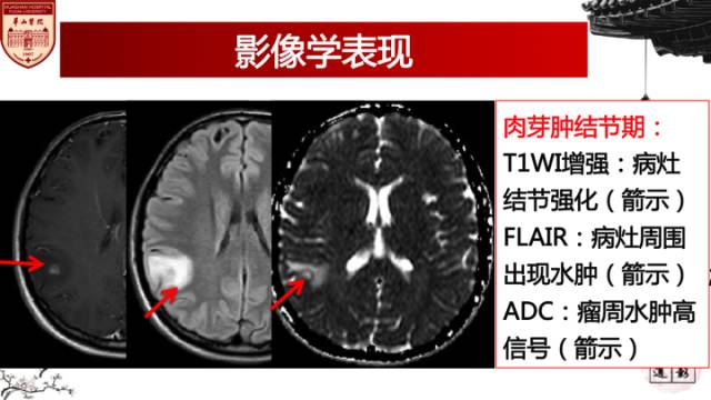 【病例】脑囊虫病1例MR影像诊断