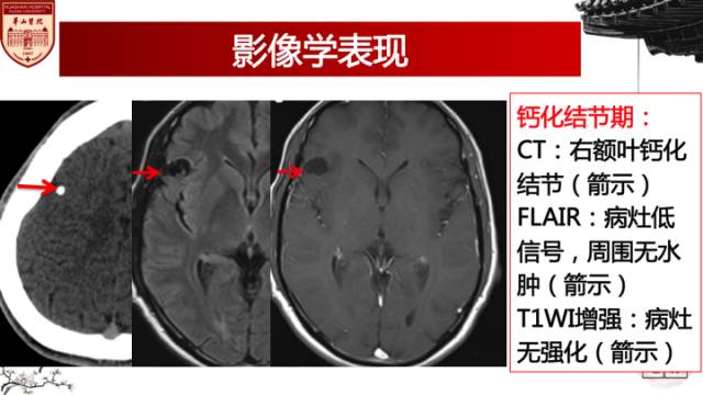 【病例】脑囊虫病1例MR影像诊断