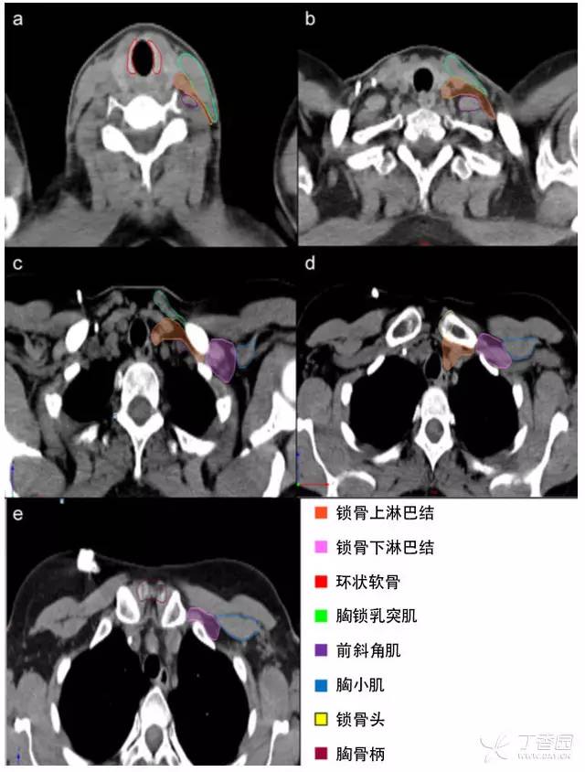 乳腺癌锁骨上淋巴结引流区 乳腺癌锁骨上淋巴结引流区