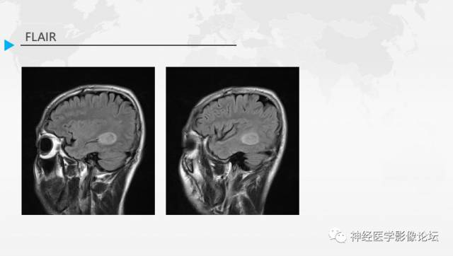 【病例】右侧颞叶室管膜下瘤1例MR