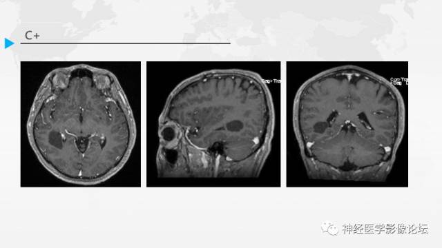 【病例】右侧颞叶室管膜下瘤1例MR