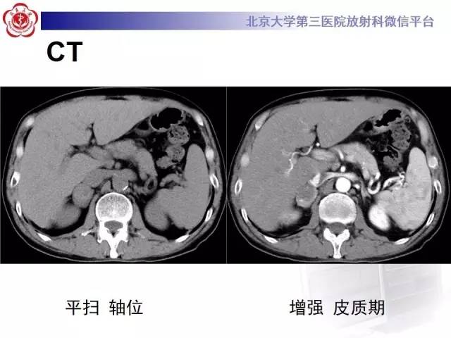 【病例】肾上腺血管瘤1例CT影像表现