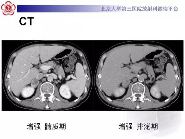 【病例】肾上腺血管瘤1例CT影像表现