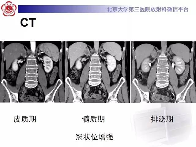 【病例】肾上腺血管瘤1例CT影像表现