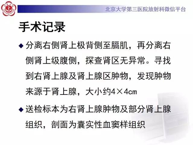 【病例】肾上腺血管瘤1例CT影像表现