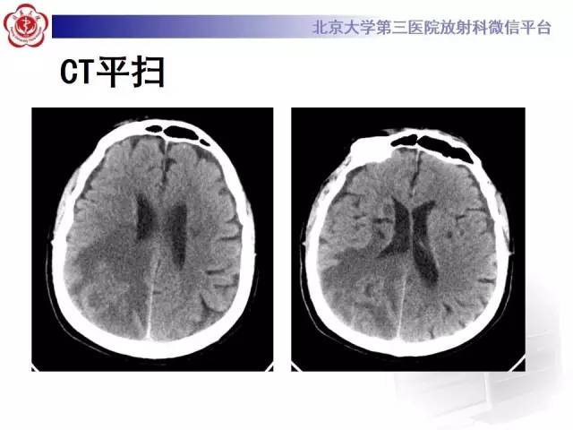 【病例】脑脓肿1例CT及MR影像诊断
