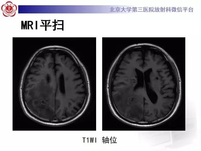 【病例】脑脓肿1例CT及MR影像诊断