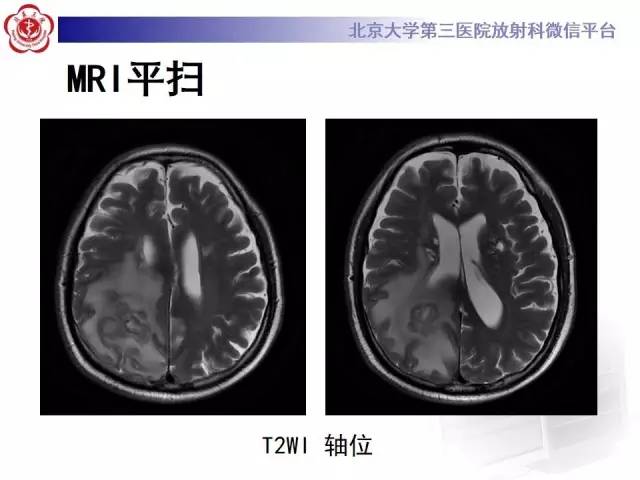 【病例】脑脓肿1例CT及MR影像诊断