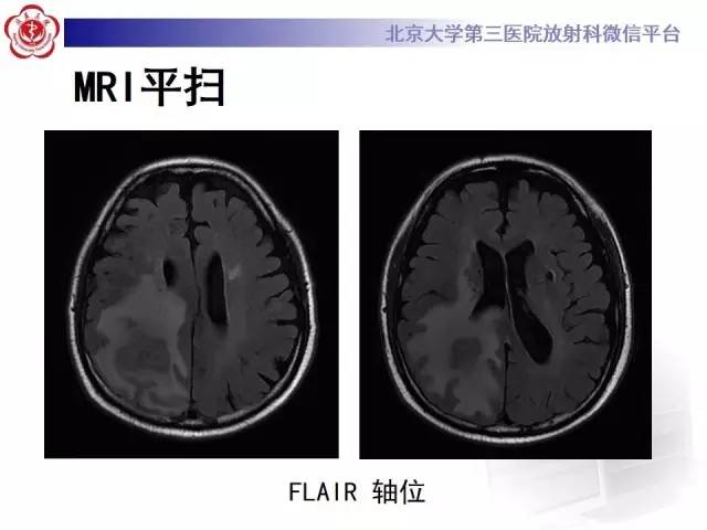 【病例】脑脓肿1例CT及MR影像诊断