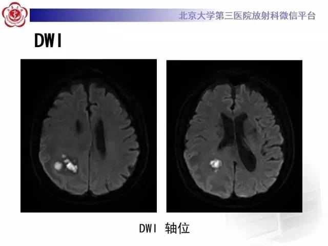 【病例】脑脓肿1例CT及MR影像诊断