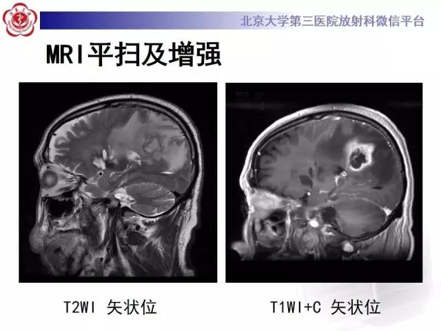 【病例】脑脓肿1例CT及MR影像诊断