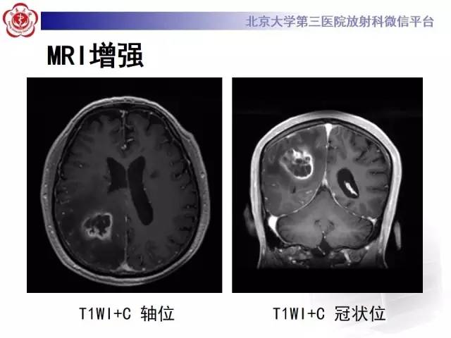 【病例】脑脓肿1例CT及MR影像诊断