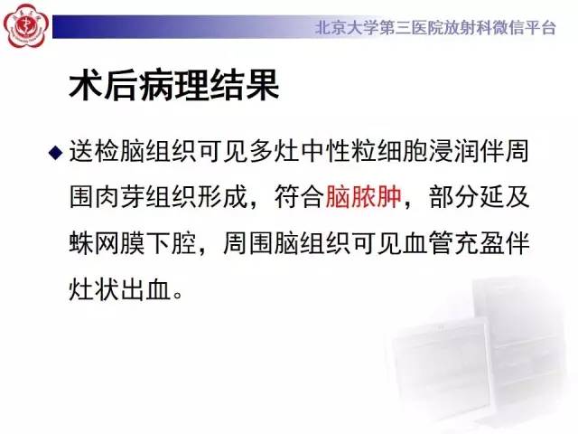【病例】脑脓肿1例CT及MR影像诊断