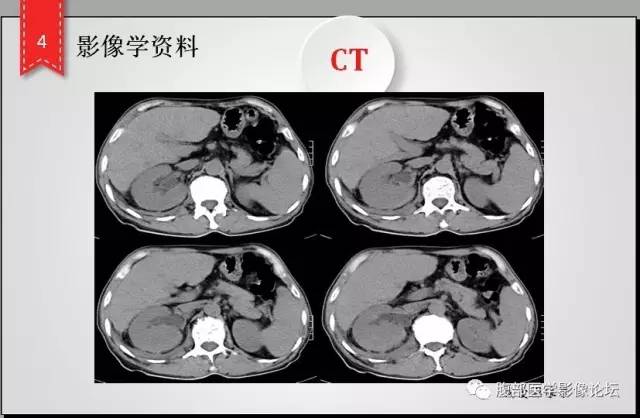 【病例】肾脏少见炎性肉芽肿伴放线菌病1例CT