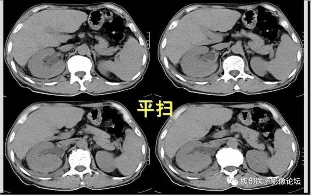 【病例】肾脏少见炎性肉芽肿伴放线菌病1例CT
