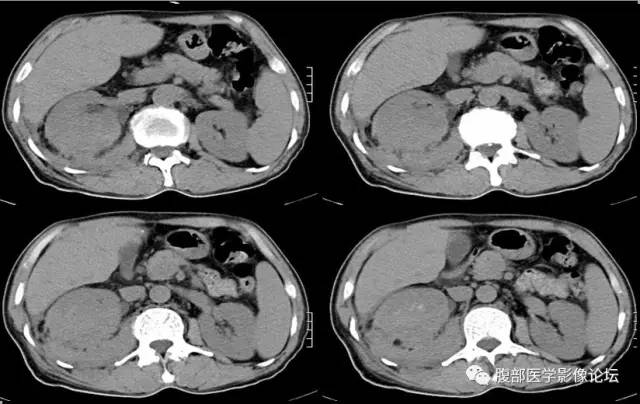 【病例】肾脏少见炎性肉芽肿伴放线菌病1例CT