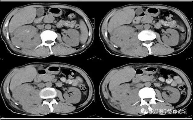 【病例】肾脏少见炎性肉芽肿伴放线菌病1例CT