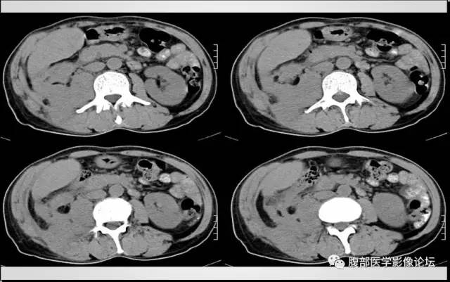 【病例】肾脏少见炎性肉芽肿伴放线菌病1例CT