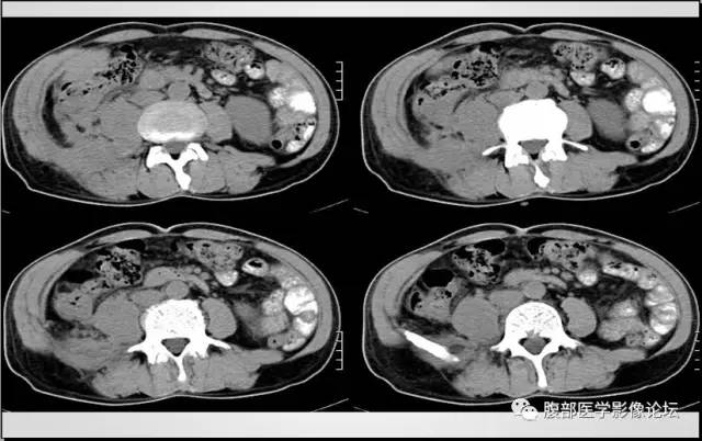 【病例】肾脏少见炎性肉芽肿伴放线菌病1例CT