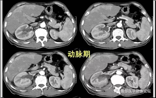 【病例】肾脏少见炎性肉芽肿伴放线菌病1例CT