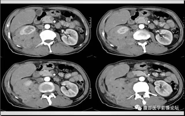 【病例】肾脏少见炎性肉芽肿伴放线菌病1例CT