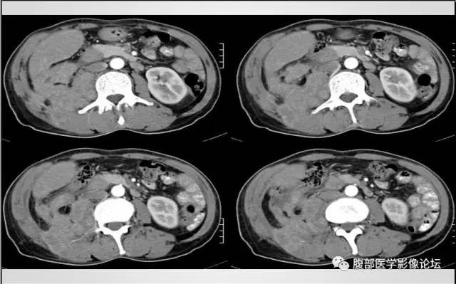 【病例】肾脏少见炎性肉芽肿伴放线菌病1例CT
