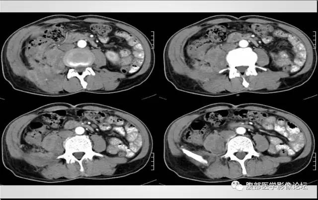【病例】肾脏少见炎性肉芽肿伴放线菌病1例CT