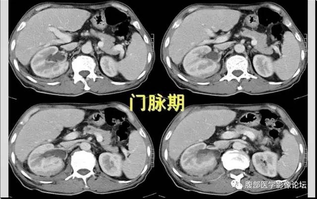 【病例】肾脏少见炎性肉芽肿伴放线菌病1例CT