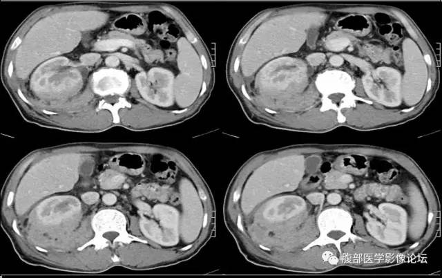 【病例】肾脏少见炎性肉芽肿伴放线菌病1例CT
