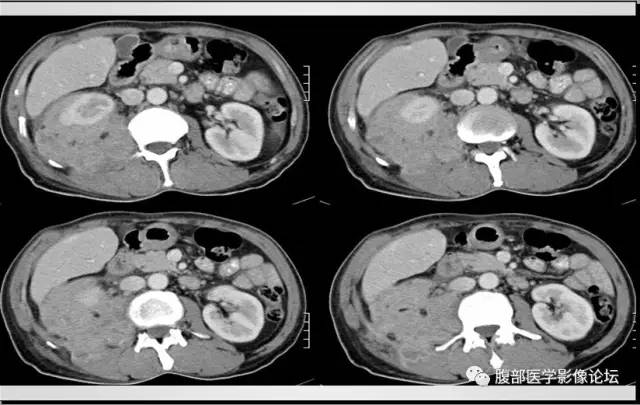 【病例】肾脏少见炎性肉芽肿伴放线菌病1例CT