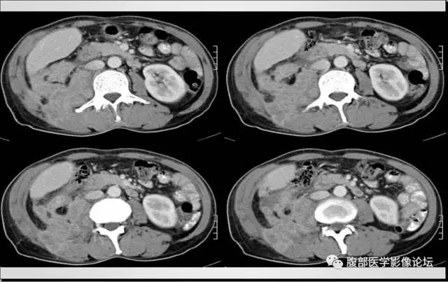 【病例】肾脏少见炎性肉芽肿伴放线菌病1例CT
