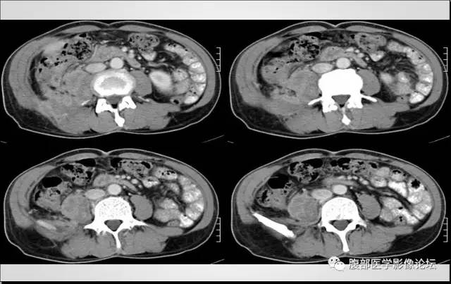 【病例】肾脏少见炎性肉芽肿伴放线菌病1例CT