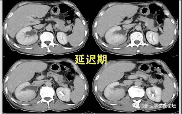 【病例】肾脏少见炎性肉芽肿伴放线菌病1例CT