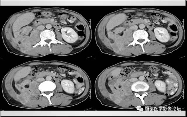 【病例】肾脏少见炎性肉芽肿伴放线菌病1例CT
