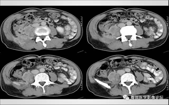 【病例】肾脏少见炎性肉芽肿伴放线菌病1例CT