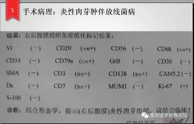 【病例】肾脏少见炎性肉芽肿伴放线菌病1例CT