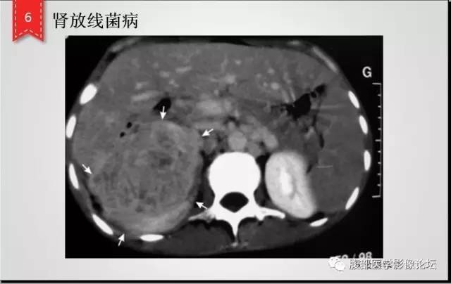 【病例】肾脏少见炎性肉芽肿伴放线菌病1例CT