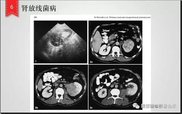 【病例】肾脏少见炎性肉芽肿伴放线菌病1例CT