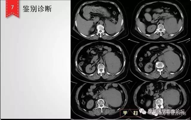 【病例】肾脏少见炎性肉芽肿伴放线菌病1例CT