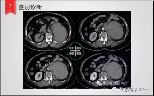【病例】肾脏少见炎性肉芽肿伴放线菌病1例CT