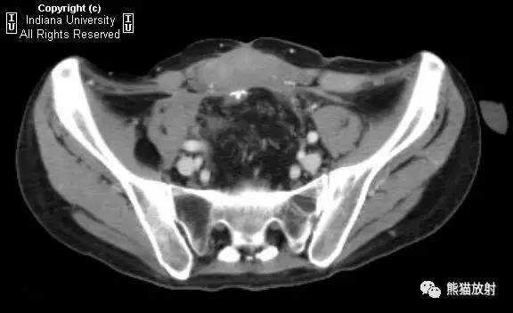 【双语病例】腹壁韧带样纤维瘤1例