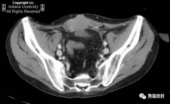 【双语病例】腹壁韧带样纤维瘤1例