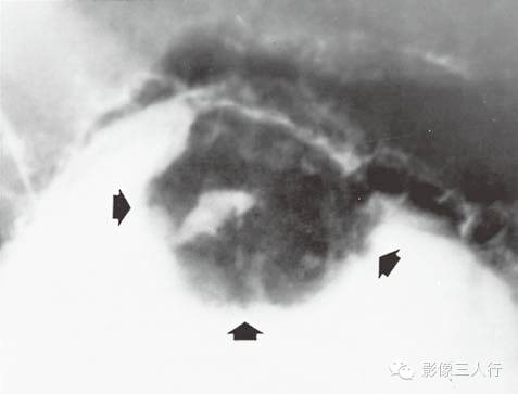 胃肠道病变的 胃肠道病变的